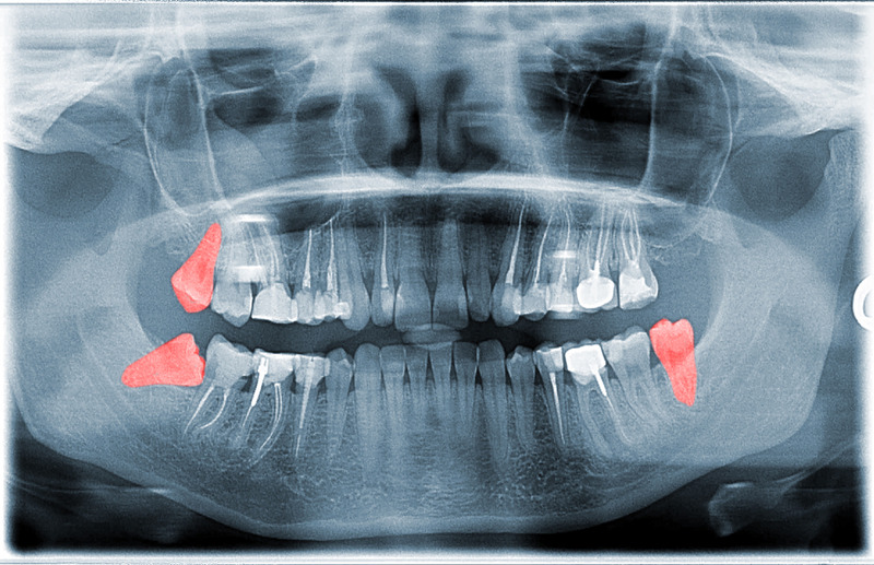 operculum-dental-surgery